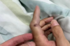 男子被鱼刺扎伤手指住进ICU：多器官功能衰竭 !