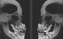 巴西一11岁女孩长了81颗牙！医生直呼活久见 ！