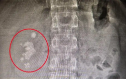 男子查出肾结石未重视拖成大麻烦：发展为铸型结石填满肾脏 !