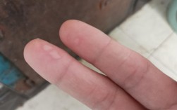 手烫出水泡应该如何处理（处理被烫出的水泡的方法和建议） ！