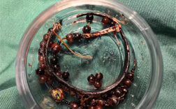 33岁女子戴手镯10年不摘：长胖后嵌进肉里严重感染 !