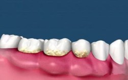 牙结石去除后牙缝变大怎么办（牙结石去除后如何处理牙缝变大的问题） ！