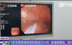 幼儿误吞电池10小时致终身残疾 医生提醒：纽扣电池卡在食道太骇人 !