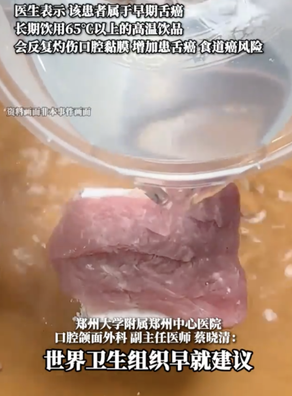 男子喝热水养生20年查出舌癌！医生：建议饮用温度不超过45℃ ！-图1